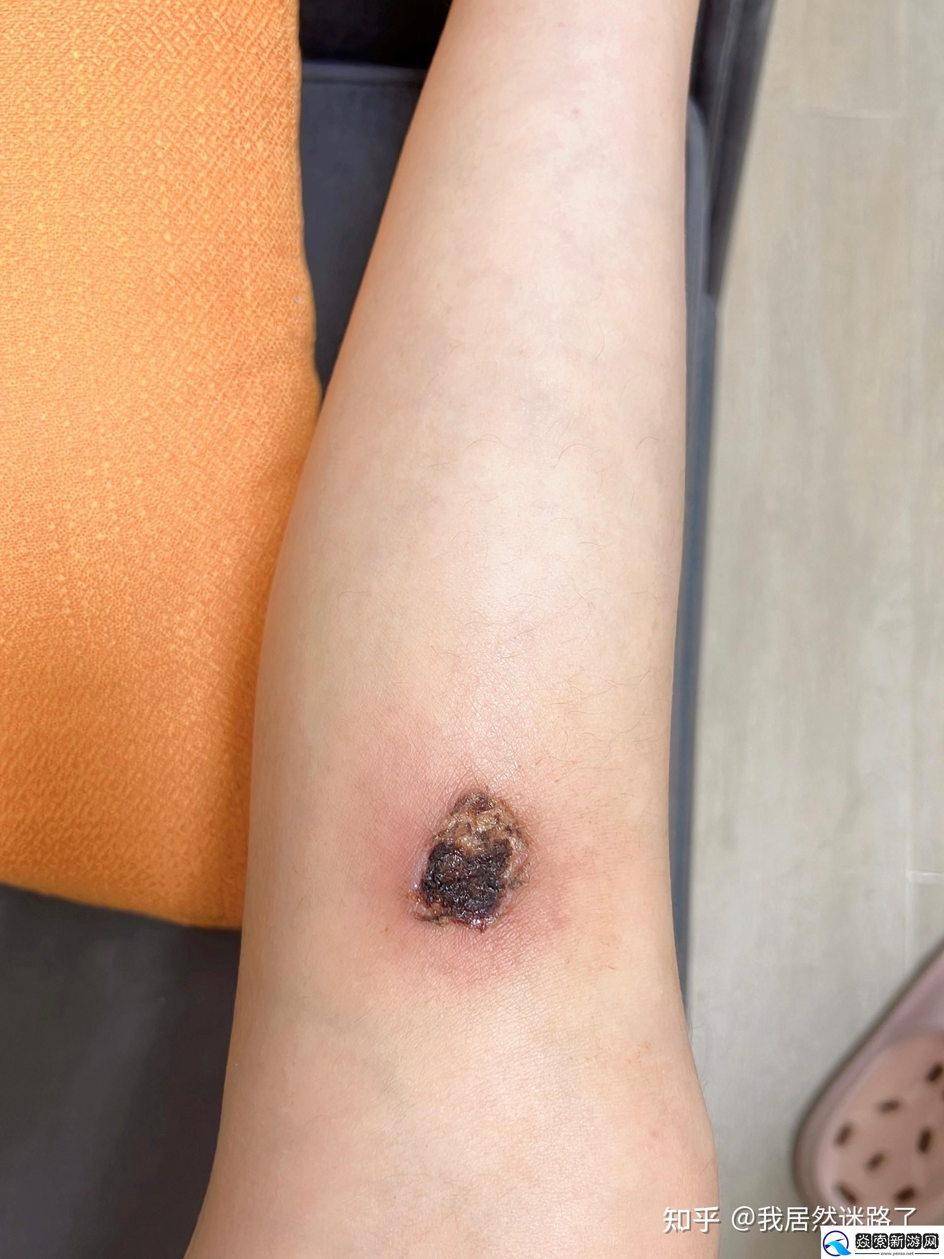 瞧瞧这科技奇观!异物穿皮入肉