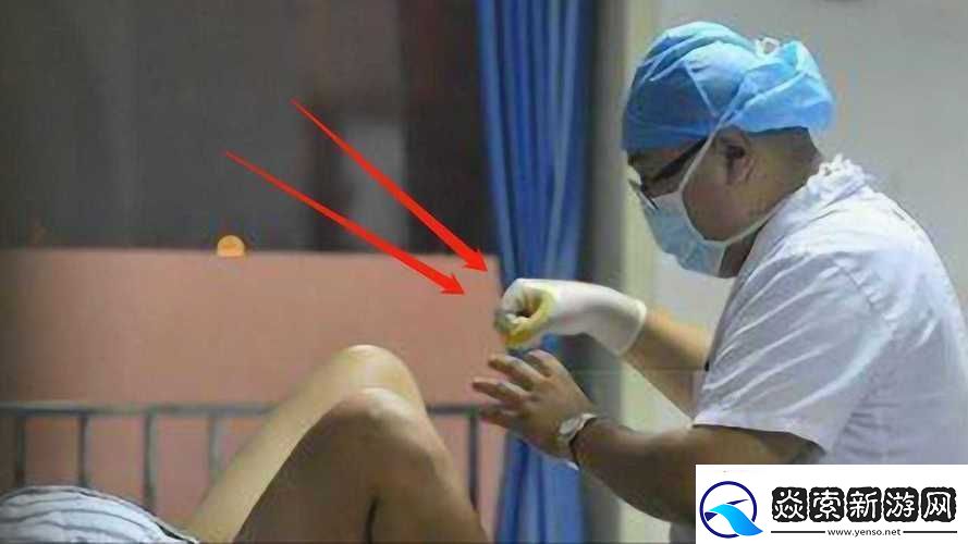 内检时医生手剥了一圈